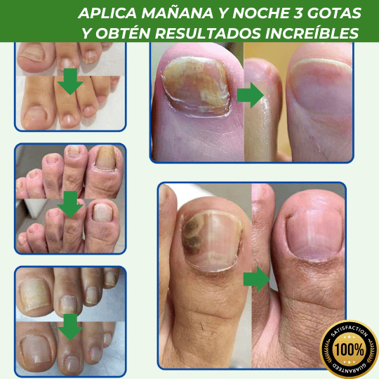 COMBO 3X1 Tratamiento Anti Hongos 14 Días