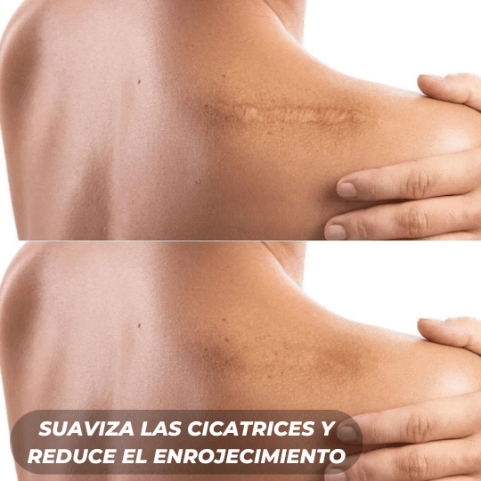 Rollo de Silicona ScarPro™ – Atenúa cicatrices y marcas visibles