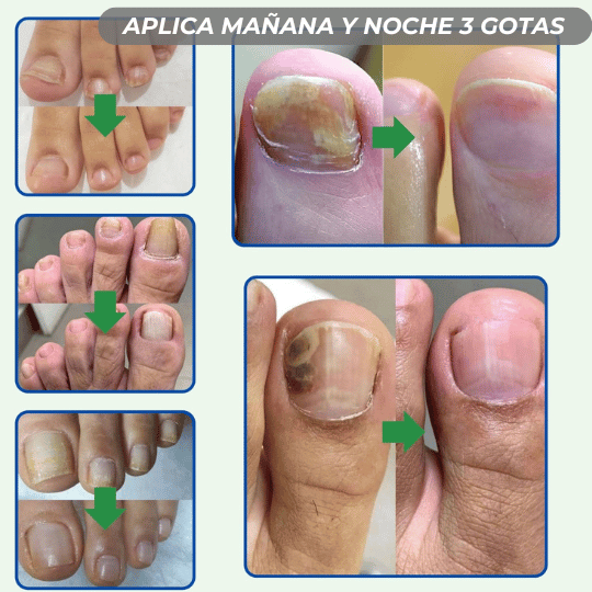 COMBO 3X1 Tratamiento Anti Hongos 14 Días